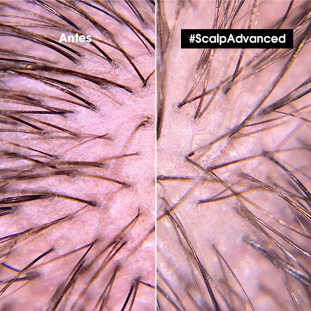 1. Shampoo Anti-Malestar para Cuero Cabelludo Sensible Scalp Advanced L’Oreal Serie Expert 300ml - Imagen 4